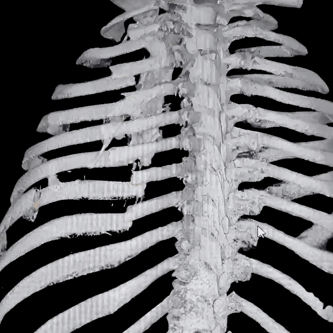 CT Scan 14 Rippenbrüche von Dr. Ribs